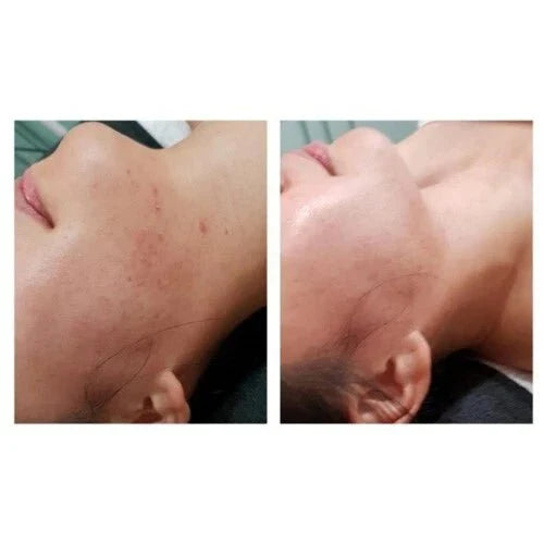 DM Cell - Organic Bio Seacil Exfola Peel Treatment Kit - XQ