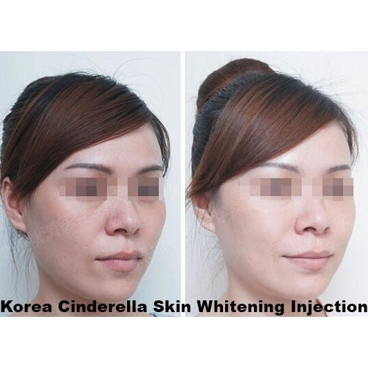 Before and after images of a woman's face showing skin whitening results.