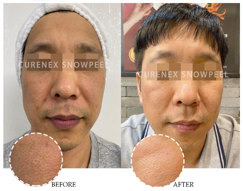 Before and after images of a man's face showing improved skin texture.
