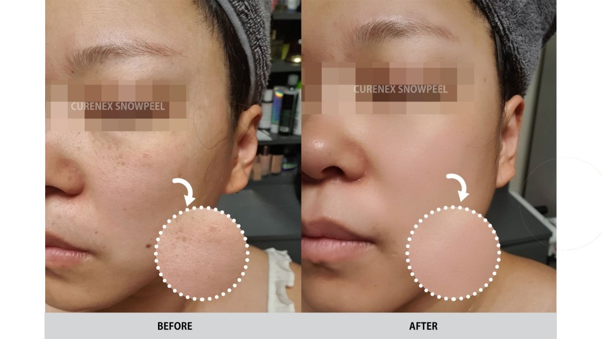 Before and after images show a person's cheek with improved skin texture and reduced pores.