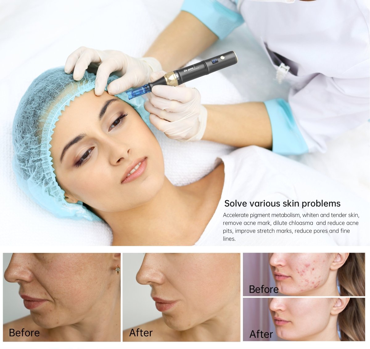 A woman receives a microneedling treatment with a Dr. Pen A8S device.