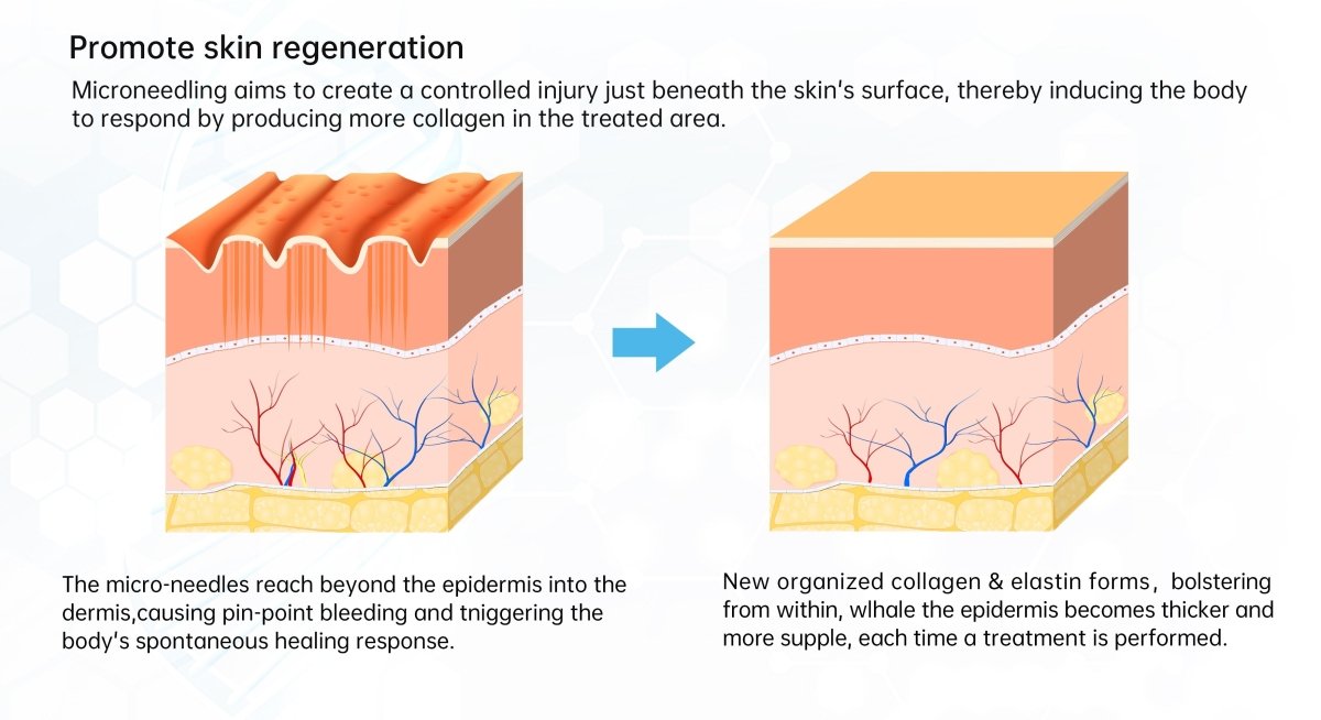 An illustration shows how microneedling creates controlled injury to promote skin regeneration.