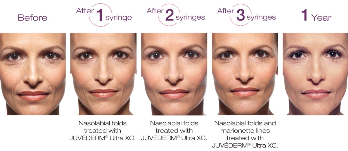 Juvéderm Ultra Plus XC (2 x 1ml)