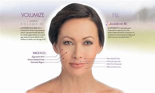 Juvederm Volux (2 x 1mI)