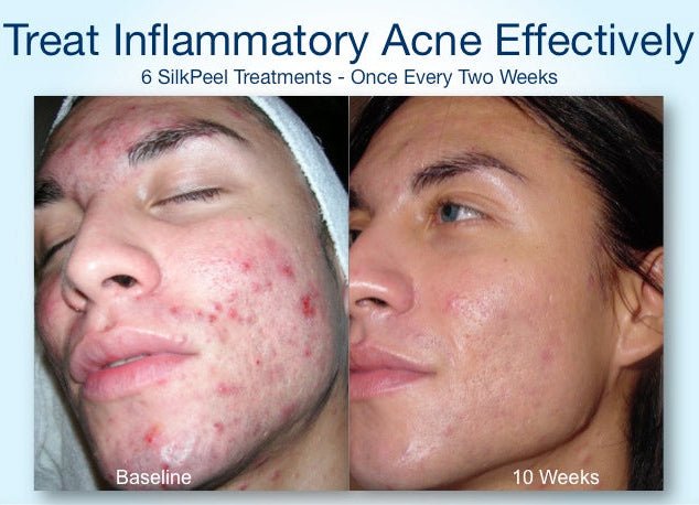 Before and after images show a person's face with reduced acne after 10 weeks.